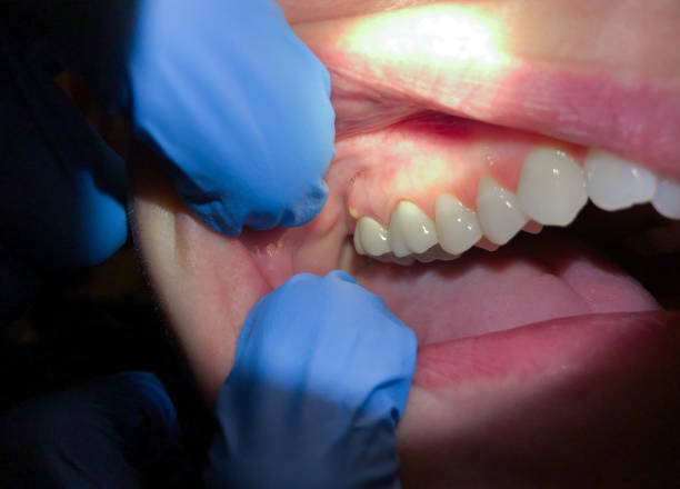 Best Emergency Denture Repair in Chickamau, GA
